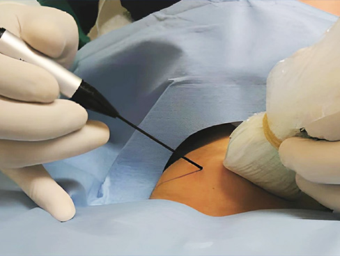 Tiroid Nodüllerinde Ameliyatsız Tedavi & Tiroid nodül ablasyonu Nedir ?